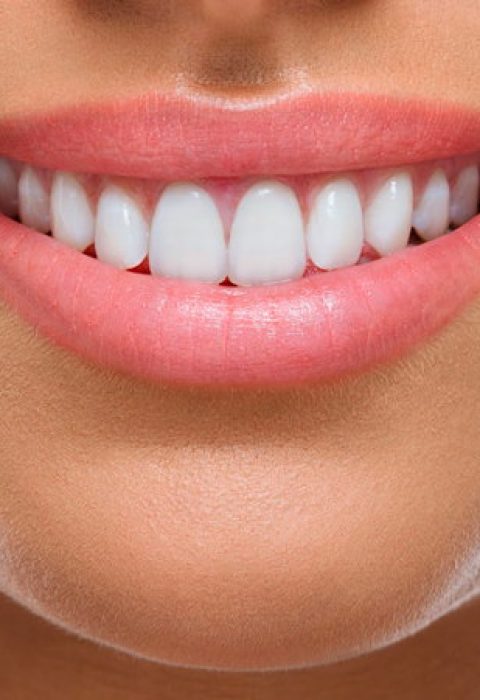 carillas-dentales1